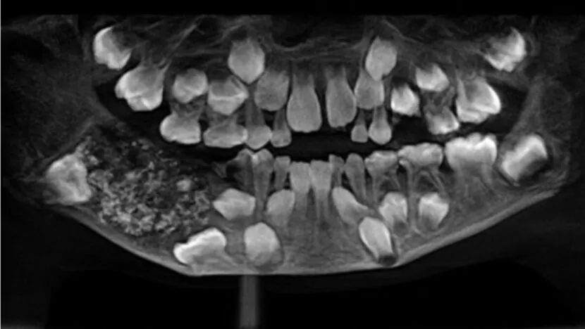 Menino de 7 anos tem 526 dentes retirados em cirurgia rara na Índia