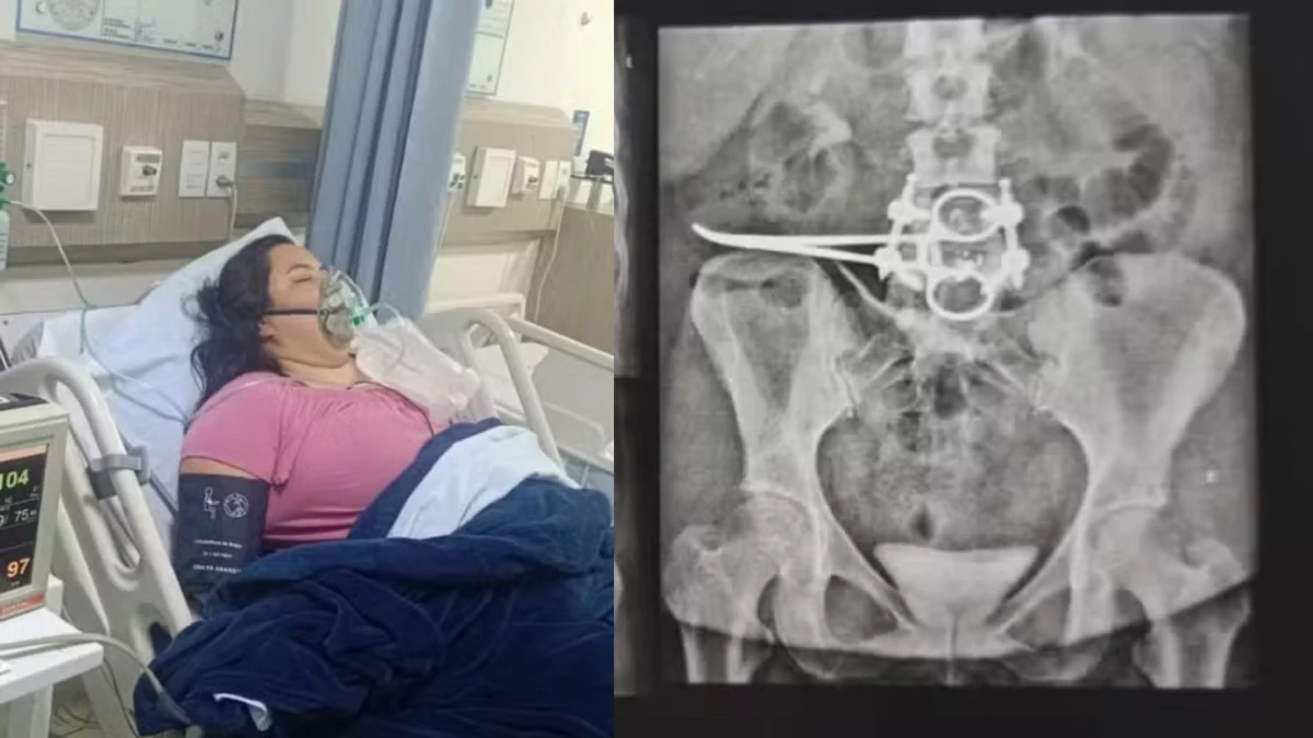 Tesoura de 18 centímetros fica em abdômen de mulher após cirurgia